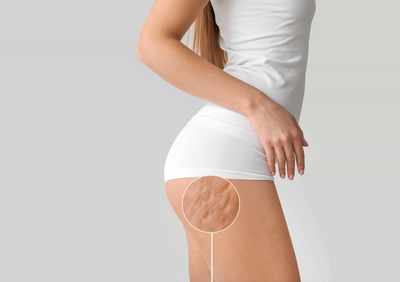 How to get rid of cellulite?