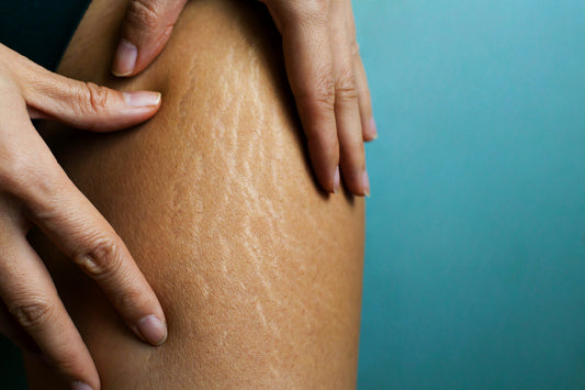 What are the causes of cellulite?