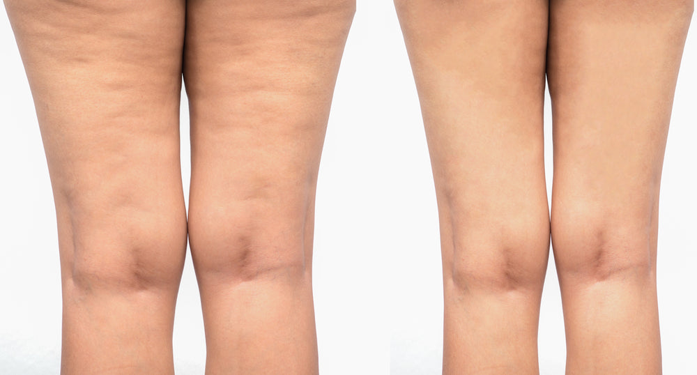 Can One’s Underwear Cause Cellulite?