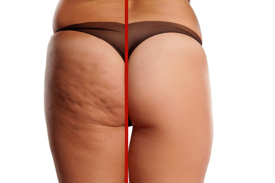 5 myths about cellulite that you have to forget|Natural ways to remove cellulite