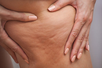 Introducing 6 natural cellulite treatment