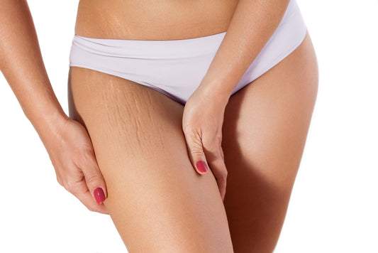 Essential Oils For Cellulite
